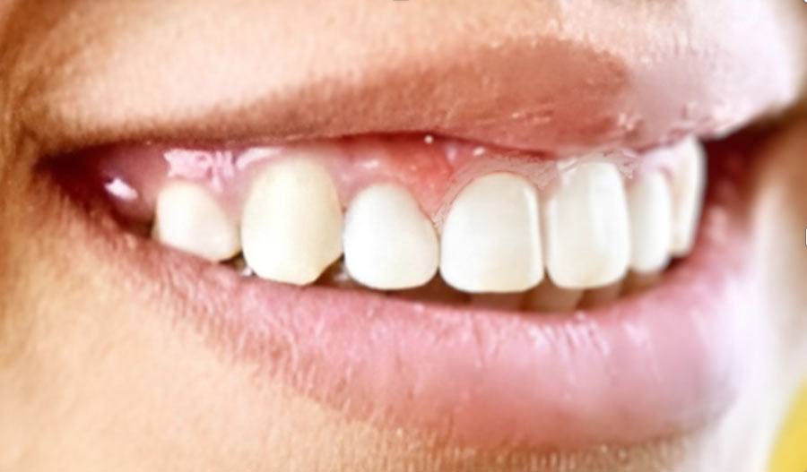 Teenage Esthetic Dentistry and 3D Printing Teeth Before and After