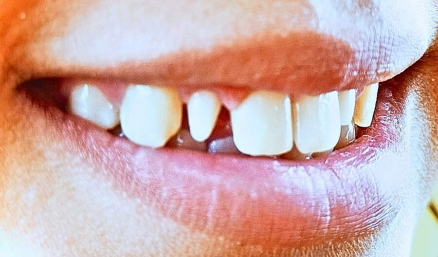 Teenage Esthetic Dentistry and 3D Printing Teeth Before and After of a smile