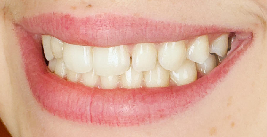 before and after teenage esthetic dentistry 3d printing tooth printed