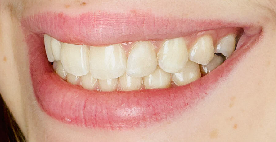 before and after teenage esthetic dentistry 3d printing tooth printed