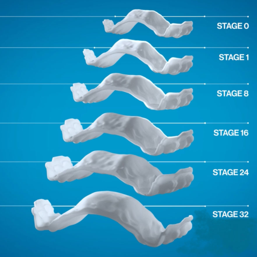 Invisalign Expander for Teen Orthodontic Care