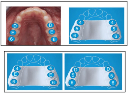 Invisalign Expander for Teen Orthodontic Care