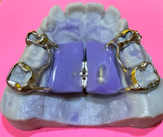 palatal expander