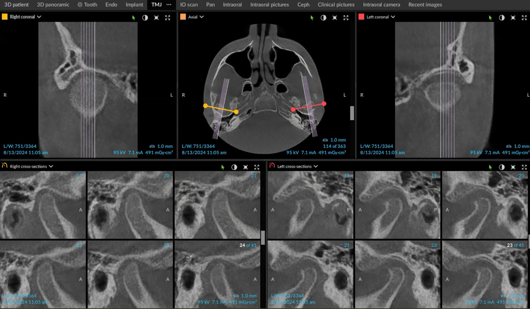 X-ray for TMJ Well-being in Teen Orthodontic Care